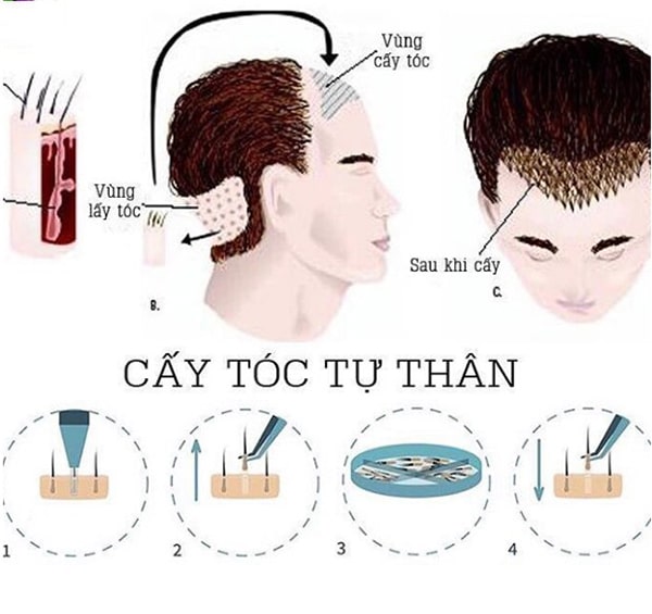 Cấy tóc tự thân - Một số điều bạn cần biết về kỹ thuật này