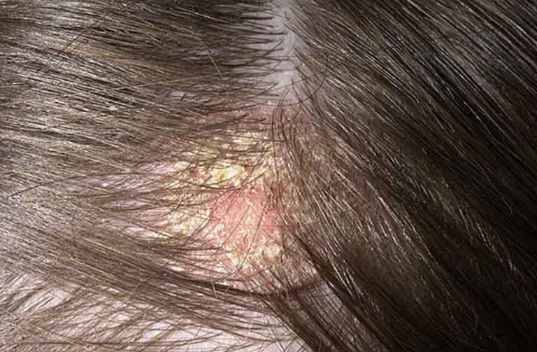 Tóc rụng nhiều ở nam: Dấu hiệu bệnh tật không thể chủ quan